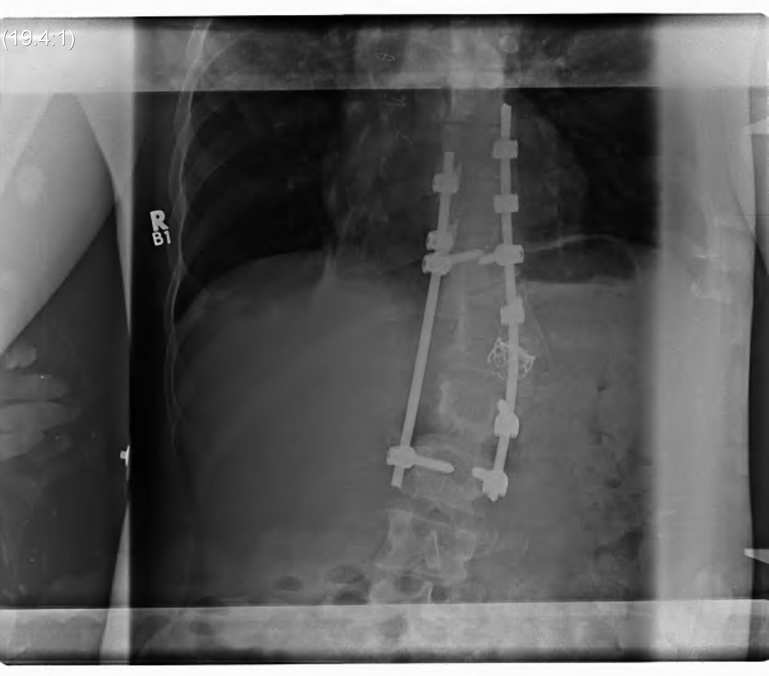 Congenital Kyphosis CT